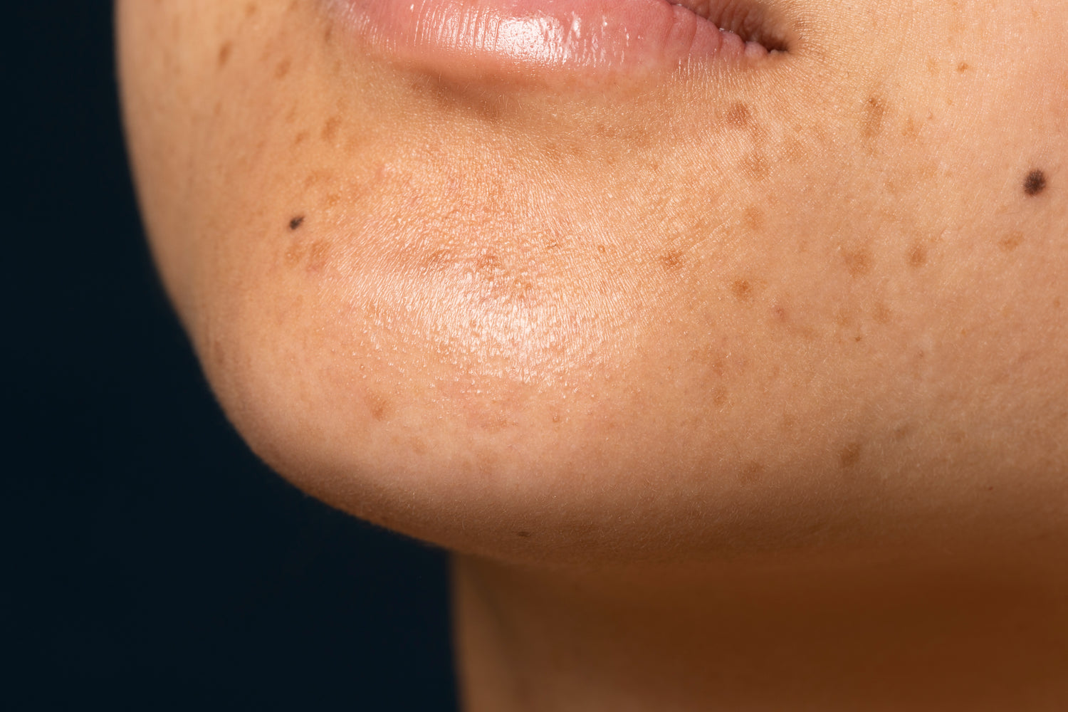 Frau mit makelloser Haut und natürlichem Teint – Fokus liegt auf dem Kinnbereich mit sichtbaren Pigmentflecken. Das Bild vermittelt Authentizität und zeigt echte Hautbedürfnisse. Es gehört zur Kategorie „Pigmentflecken“ und dient als visuelle Empfehlung für gezielte Naturkosmetik-Produkte von Pure Elements.